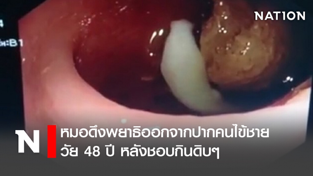หมอดึงพยาธิออกจากปากคนไข้ชายวัย 48 ปี หลังชอบกินดิบๆ หมอดึงพยาธิออกจากปากคนไข้ชายวัย 48 ปี หลังชอบกินดิบๆ