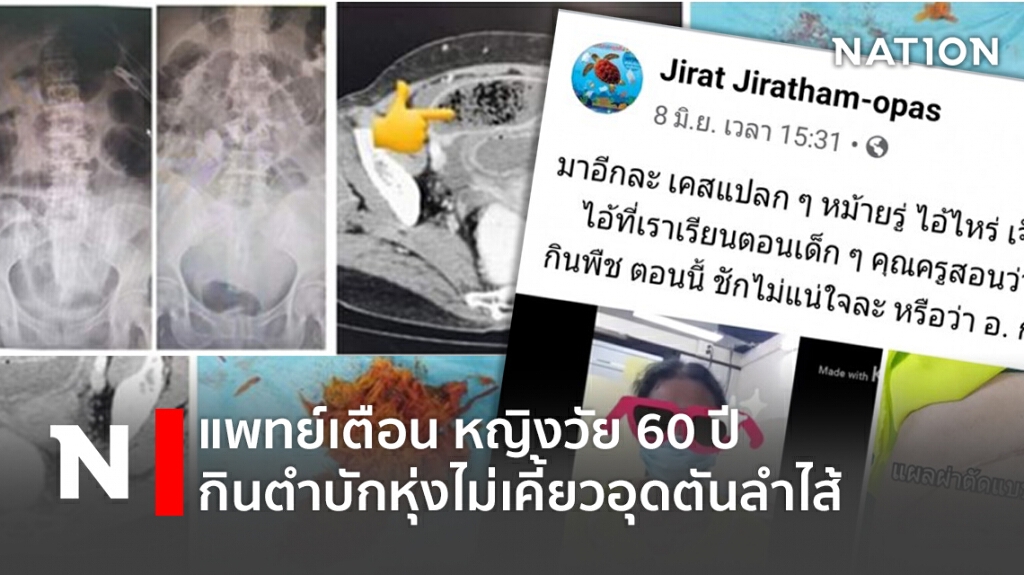 แพทย์เตือน หญิงวัย 60 ปี กินตำบักหุ่งไม่เคี้ยวอุดตันลำไส้ แพทย์เตือน หญิงวัย 60 ปี กินตำบักหุ่งไม่เคี้ยวอุดตันลำไส้