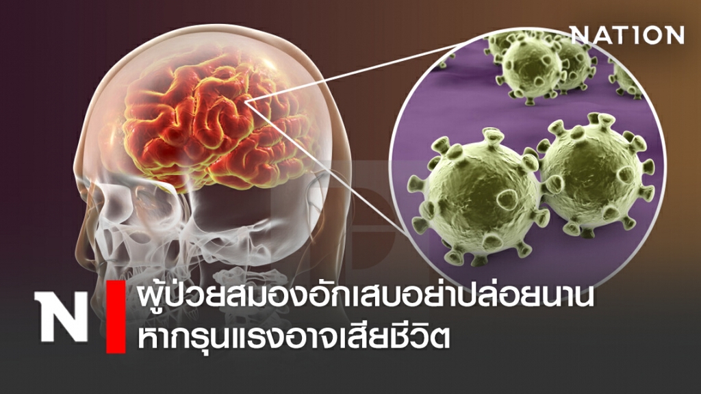 แพทย์เตือนผู้ป่วยโรคสมองอักเสบอย่าปล่อยนาน หากรุนแรงอาจเสียชีวิต