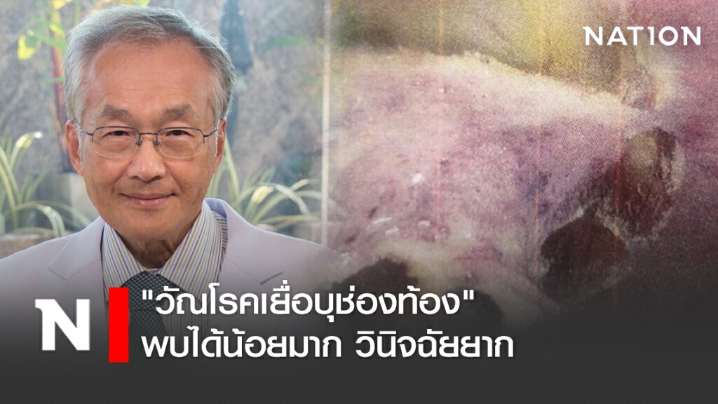 หมอมนูญ ระบุ"วัณโรคเยื่อบุช่องท้อง" พบได้น้อยมาก วินิจฉัยยาก