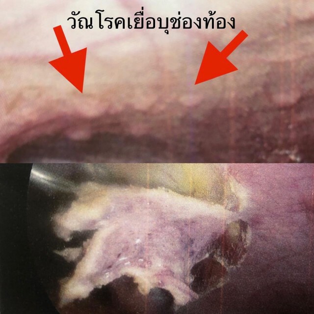 หมอมนูญ ระบุ"วัณโรคเยื่อบุช่องท้อง" พบได้น้อยมาก วินิจฉัยยาก