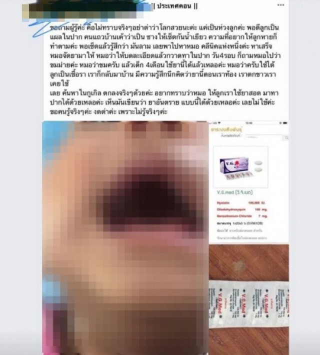 หมอถึงกับมึน! คุณแม่เชื่อคนแถวบ้านเอาปัสสาวะป้ายแผลในปากลูก