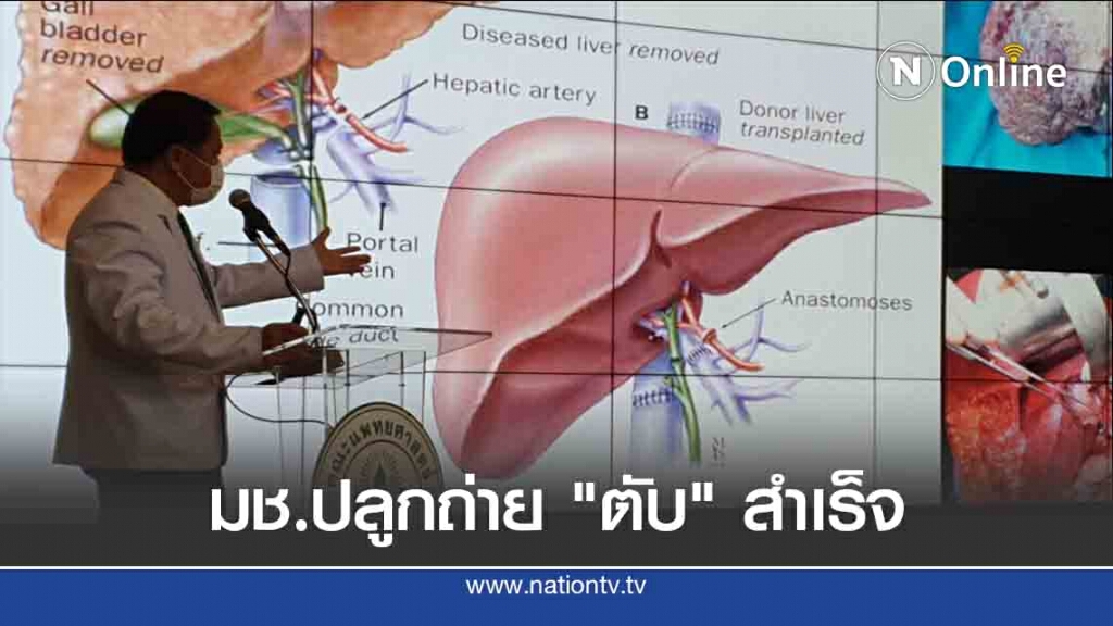 มช.ปลูกถ่ายตับจากผู้บริจาคมีชีวิตสำเร็จ