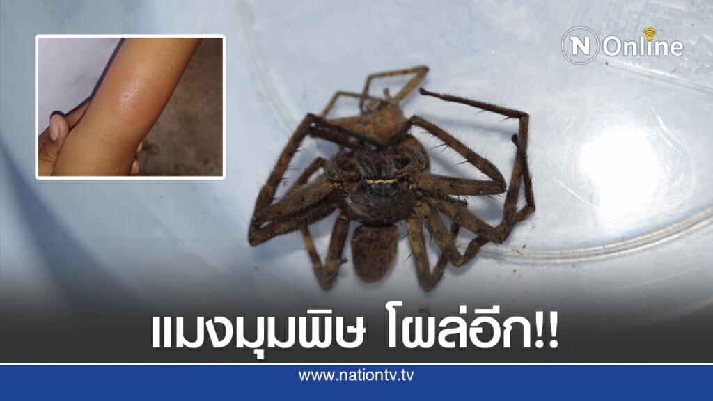 แมงมุมพิษโผล่กัดเด็ก 8 ขวบอีกราย แมงมุมพิษโผล่กัดเด็ก 8 ขวบอีกราย