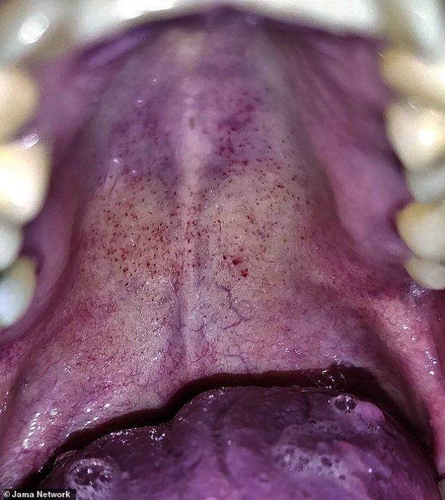 นักวิจัยพบ "แผลในปาก" โยงโควิด-19