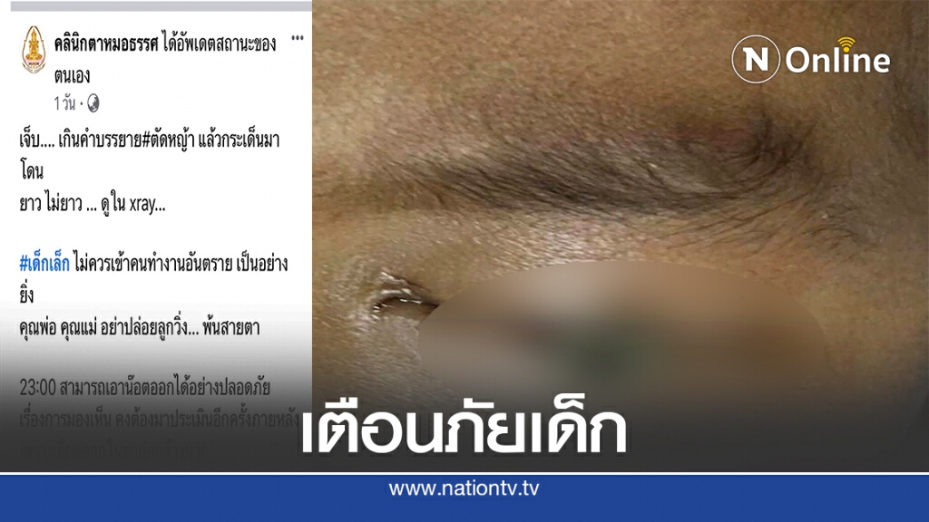เด็ก 3 ขวบถูกน็อตกระเด็นทิ่มตา ขณะเครื่องตัดหญ้าทำงาน