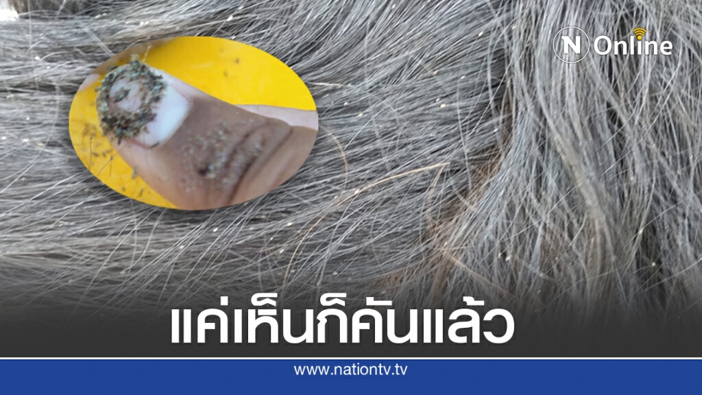กองทัพเหาบุกหัวเด็กหญิง ถามชาวเน็ต แนะวิธีกำจัด กองทัพเหาบุกหัวเด็กหญิง ถามชาวเน็ต แนะวิธีกำจัด