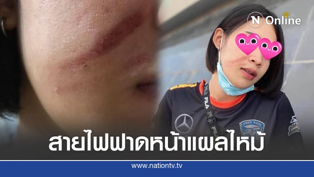 แม่เดือดลูกถูกสายไฟร่วงฟาดหน้าแผลไหม้ไร้หน่วยงานเหลียวแล แม่เดือดลูกถูกสายไฟร่วงฟาดหน้าแผลไหม้ไร้หน่วยงานเหลียวแล