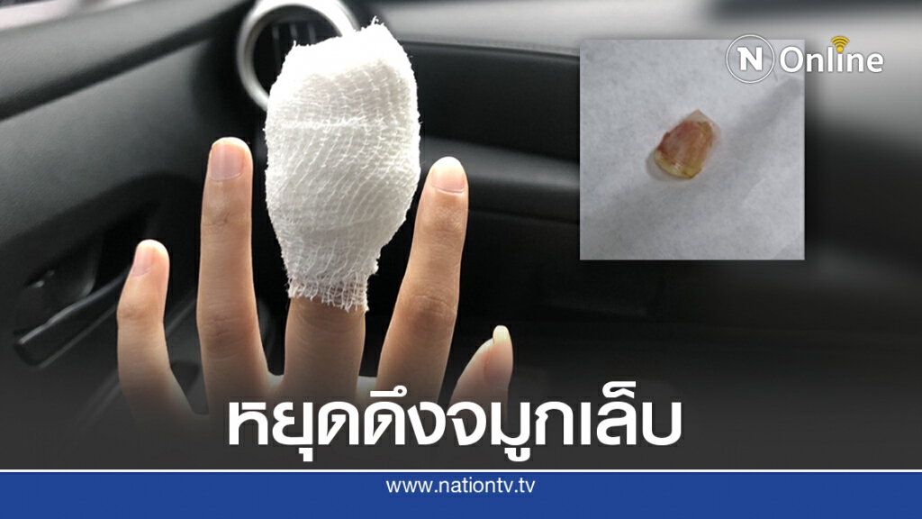 สาวโพสต์เตือนหนองขึ้น เชื้อโรคเข้าเหตุจากดึงจมูกเล็บ