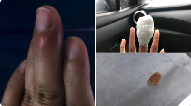 สาวโพสต์เตือนหนองขึ้น เชื้อโรคเข้าเหตุจากดึงจมูกเล็บ