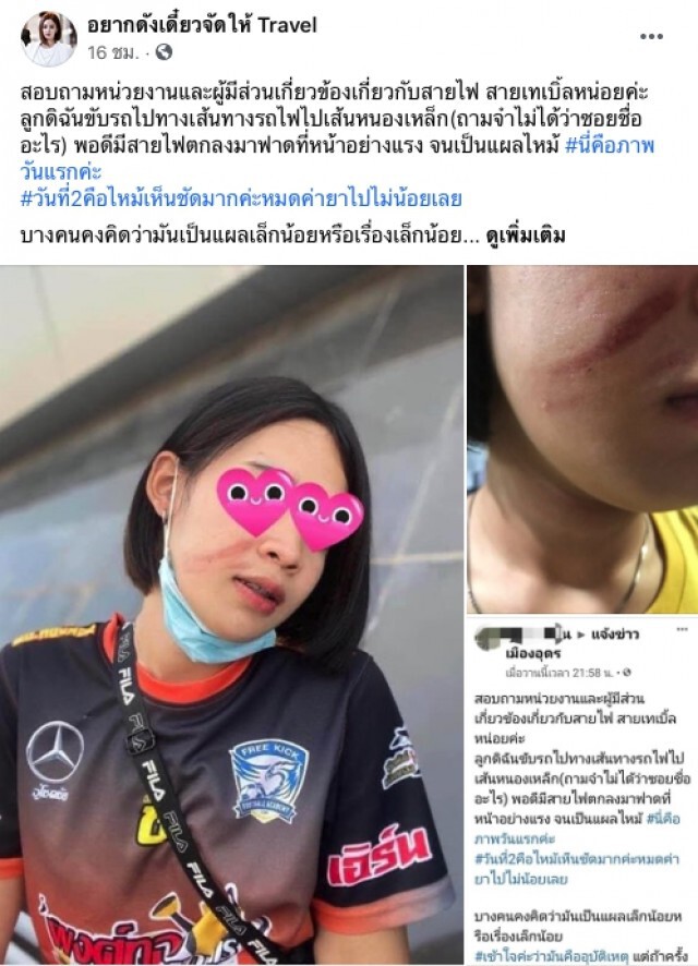 แม่เดือดลูกถูกสายไฟร่วงฟาดหน้าแผลไหม้ไร้หน่วยงานเหลียวแล