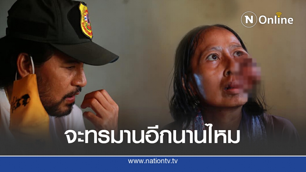 บิณฑ์ช่วยเหลือหญิงป่วยมะเร็งที่แก้ม ตัดพ้ออีกนานไหมกว่าจะหมดลม