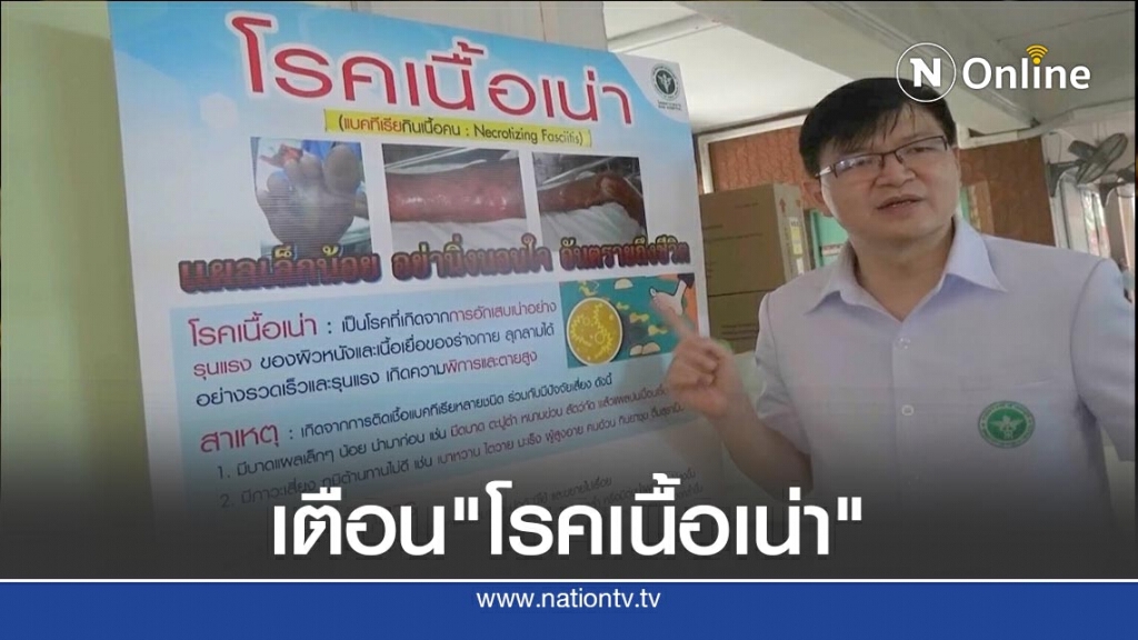 เตือน"โรคเนื้อเน่า"-แบคทีเรียกินเนื้อคน