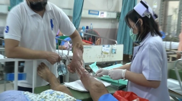 เตือน"โรคเนื้อเน่า"-แบคทีเรียกินเนื้อคน