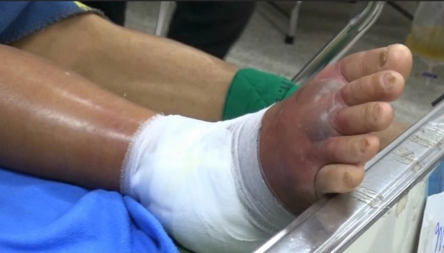 เตือน"โรคเนื้อเน่า"-แบคทีเรียกินเนื้อคน