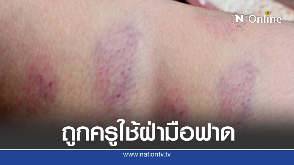 แม่โวยครูเอาสมุดตีหัวฝ่ามือฟาดหลังลูก7 ขวบเป็นรอยเขียว แม่โวยครูเอาสมุดตีหัวฝ่ามือฟาดหลังลูก7 ขวบเป็นรอยเขียว