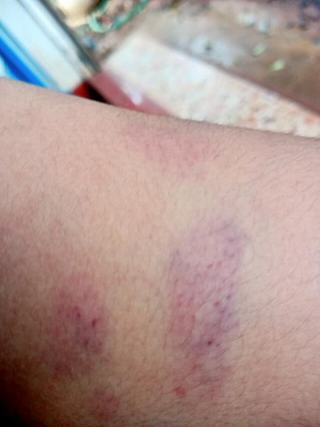 แม่โวยครูเอาสมุดตีหัวฝ่ามือฟาดหลังลูก7 ขวบเป็นรอยเขียว