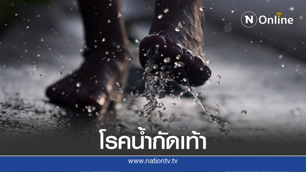 6 วิธีการดูแลผู้ป่วย "โรคน้ำกัดเท้า" ในช่วงหน้าฝน