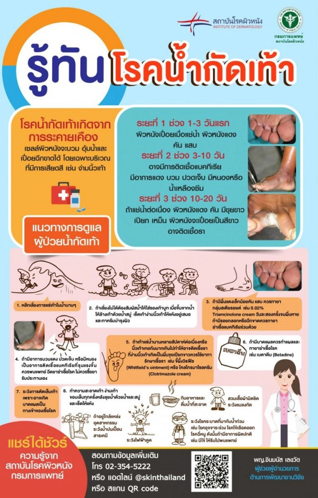 6 วิธีการดูแลผู้ป่วย "โรคน้ำกัดเท้า" ในช่วงหน้าฝน