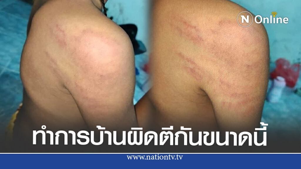 แม่แจ้งความ ลูกป.2 ถูกครูหัวร้อนตีรอยเต็มตัว เหตุทำการบ้านผิด