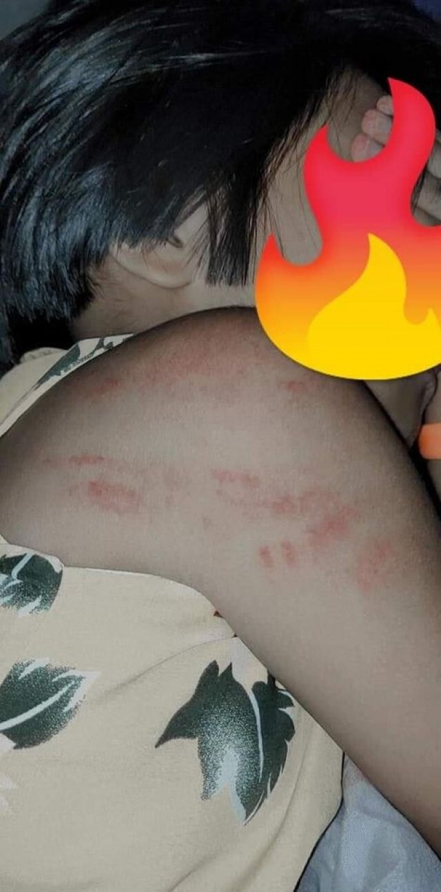 แม่แจ้งความ ลูกป.2 ถูกครูหัวร้อนตีรอยเต็มตัว เหตุทำการบ้านผิด