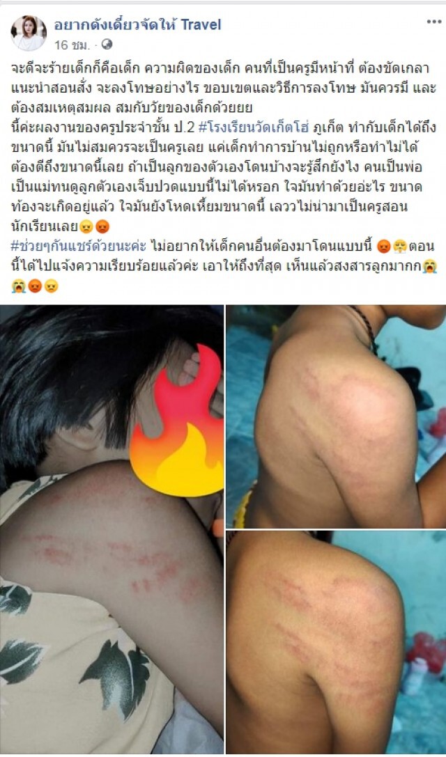แม่แจ้งความ ลูกป.2 ถูกครูหัวร้อนตีรอยเต็มตัว เหตุทำการบ้านผิด
