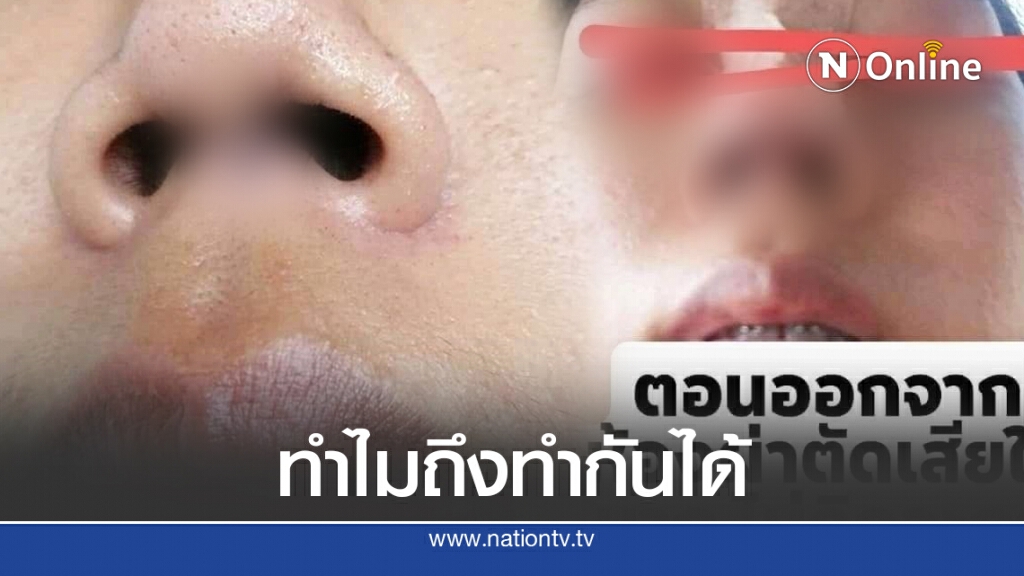 เหยื่อเคราะห์ร้าย เข้าทำศัลยกรรมจมูก เจอหมอเถื่อนหลอกล่อเสียเกือบแสน ผลลัพธ์บิดเบี้ยว ผิดรูป
