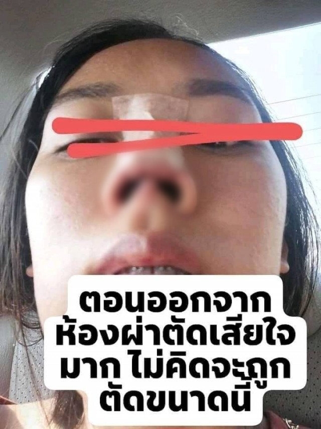 เหยื่อเคราะห์ร้าย เข้าทำศัลยกรรมจมูก เจอหมอเถื่อนหลอกล่อเสียเกือบแสน ผลลัพธ์บิดเบี้ยว ผิดรูป