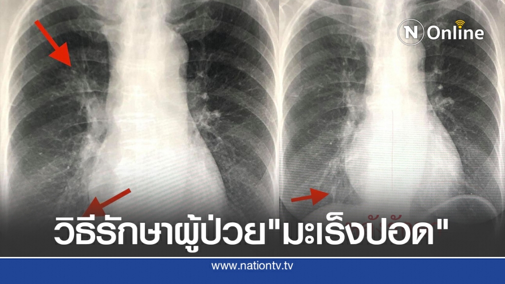"หมอมนูญ" เผยวิธีรักษาผู้ป่วย"มะเร็งปอด" ด้วยยาพุ่งเป้า ภูมิคุ้มกันบำบัด