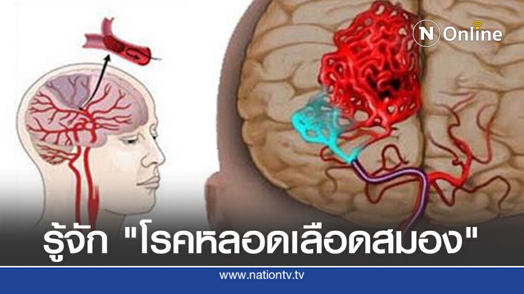 รู้จัก "โรคหลอดเลือดสมอง" สาเหตุอัมพฤกษ์-อัมพาต ภัยร้ายที่ไม่ควรมองข้าม