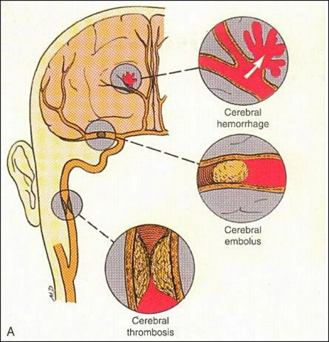 รู้จัก "โรคหลอดเลือดสมอง" สาเหตุอัมพฤกษ์-อัมพาต ภัยร้ายที่ไม่ควรมองข้าม