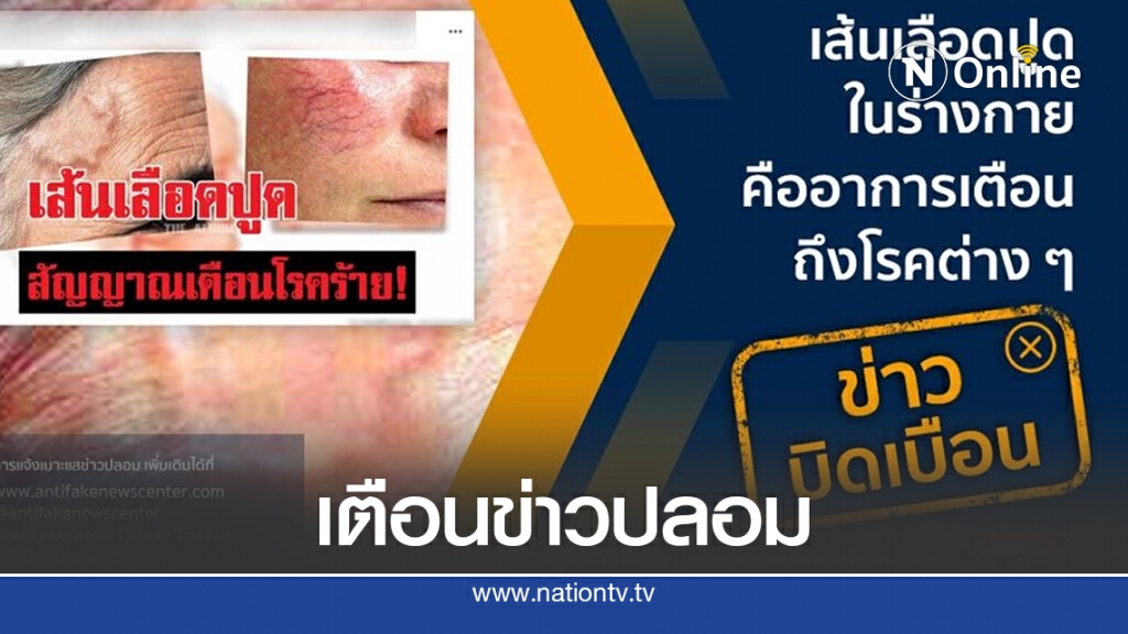 ข่าวนี้ไม่ควรแชร์!! เส้นเลือดปูดในร่างกาย คืออาการเตือนถึงโรคต่าง ๆ