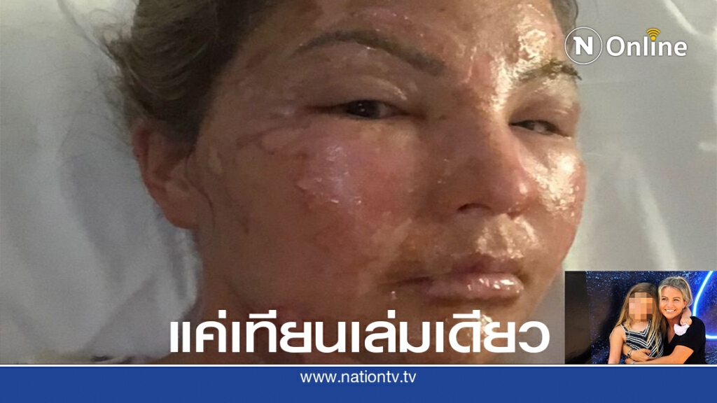 สาวเสียโฉมหลังขวดใส่น้ำยาล้างมือติดไฟขณะที่จุดเทียน สาวเสียโฉมหลังขวดใส่น้ำยาล้างมือติดไฟขณะที่จุดเทียน