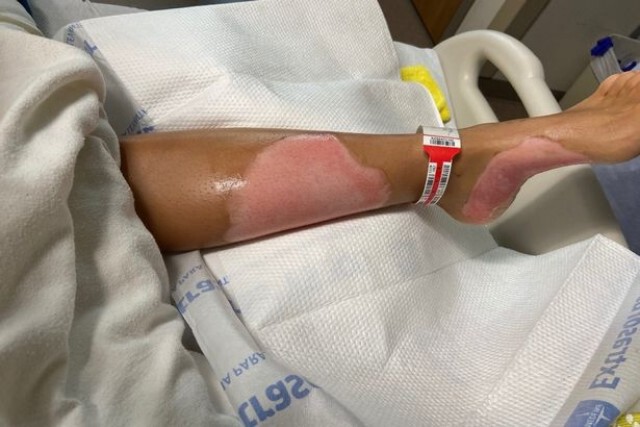 สาวเสียโฉมหลังขวดใส่น้ำยาล้างมือติดไฟขณะที่จุดเทียน
