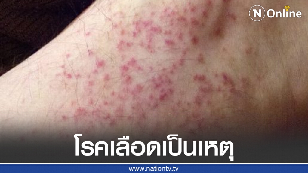 จุดแดง-จ้ำเขียว หรือ พรายย้ำ สาเหตุมาจากโรคเลือด