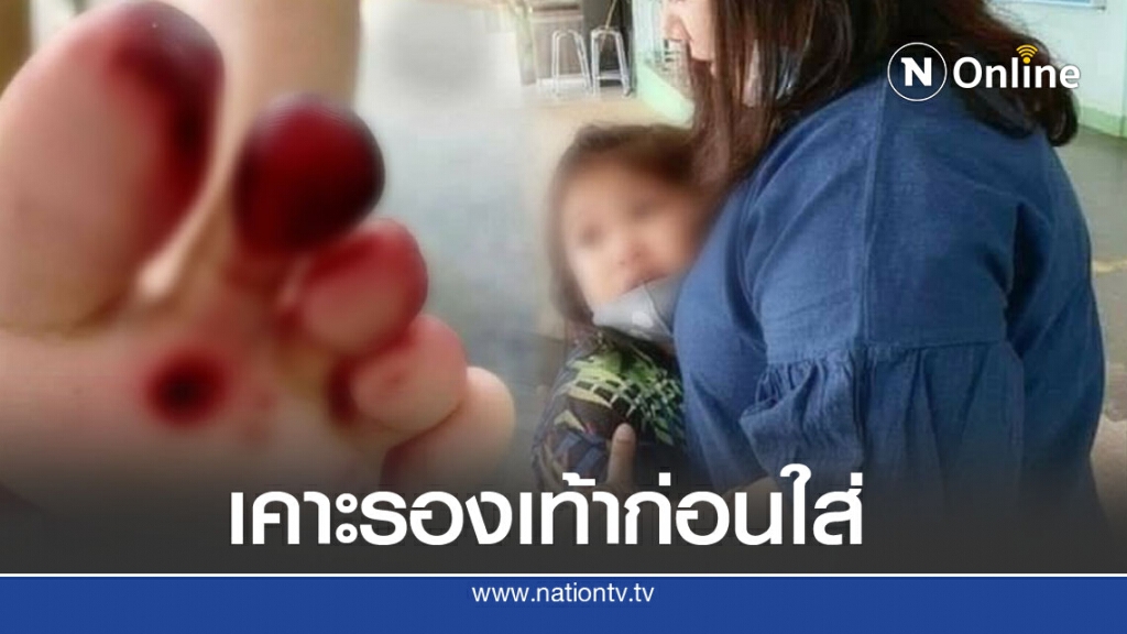 แม่แชร์อุทาหรณ์ หลังเห็นนิ้วเท้าลูกบวมแดง หาสาเหตุพบมีสัตว์แอบอยู่ในรองเท้า แม่แชร์อุทาหรณ์ หลังเห็นนิ้วเท้าลูกบวมแดง หาสาเหตุพบมีสัตว์แอบอยู่ในรองเท้า