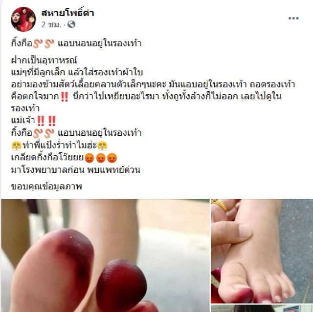 แม่แชร์อุทาหรณ์ หลังเห็นนิ้วเท้าลูกบวมแดง หาสาเหตุพบมีสัตว์แอบอยู่ในรองเท้า