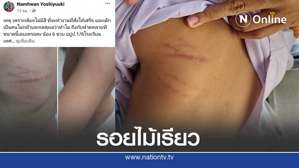 แรงไปไหม?? แม่ถามคุณครูตีลูกจนช้ำเลือด แรงไปไหม?? แม่ถามคุณครูตีลูกจนช้ำเลือด