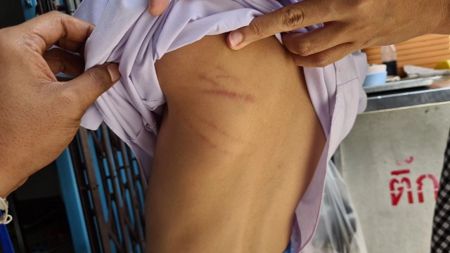 แรงไปไหม?? แม่ถามคุณครูตีลูกจนช้ำเลือด