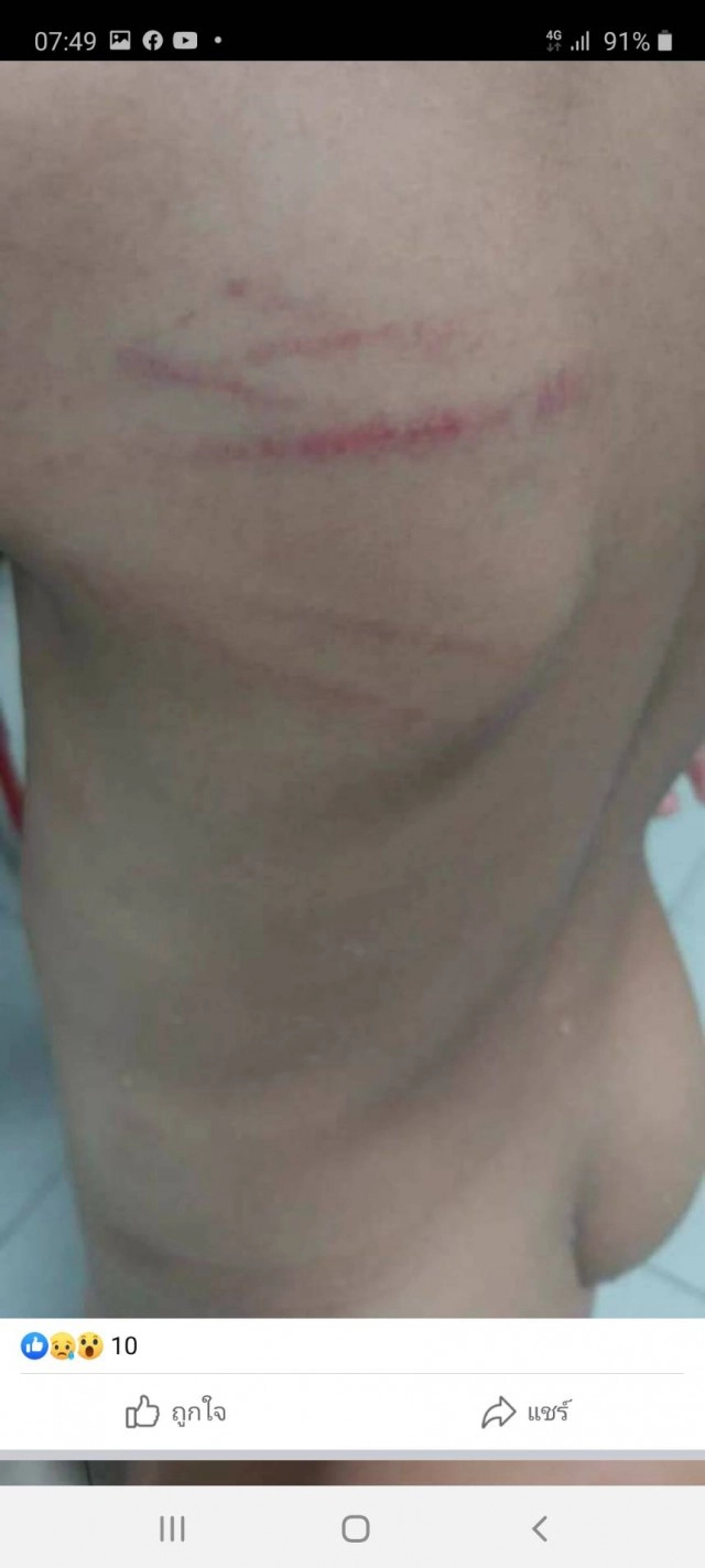 แรงไปไหม?? แม่ถามคุณครูตีลูกจนช้ำเลือด