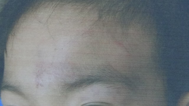 แม่ร้องลูกป.2 ถูกรุ่นพี่ ม.3 ทำร้าย รร.ไม่เหลียวแล