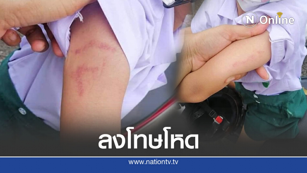 โผล่อีกราย แม่โพสต์ลูกชั้นอนุบาล 2 รร.เอกชนชื่อดัง ถูกครูทำร้าย พบร่องรอยคล้ายรอยหยิก