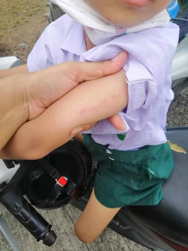 โผล่อีกราย แม่โพสต์ลูกชั้นอนุบาล 2 รร.เอกชนชื่อดัง ถูกครูทำร้าย พบร่องรอยคล้ายรอยหยิก