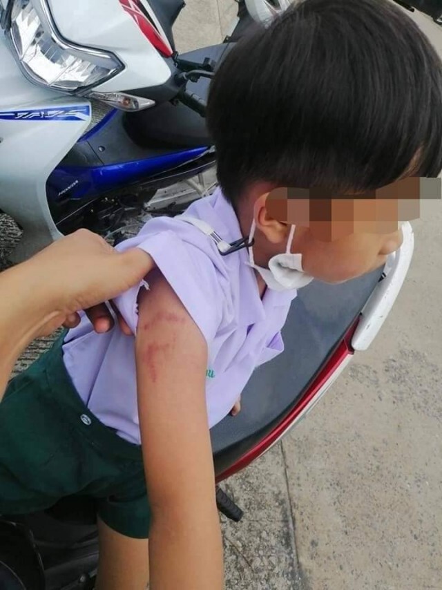โผล่อีกราย แม่โพสต์ลูกชั้นอนุบาล 2 รร.เอกชนชื่อดัง ถูกครูทำร้าย พบร่องรอยคล้ายรอยหยิก