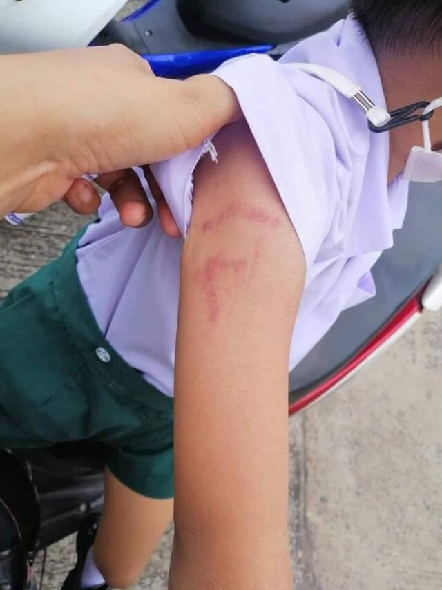 โผล่อีกราย แม่โพสต์ลูกชั้นอนุบาล 2 รร.เอกชนชื่อดัง ถูกครูทำร้าย พบร่องรอยคล้ายรอยหยิก