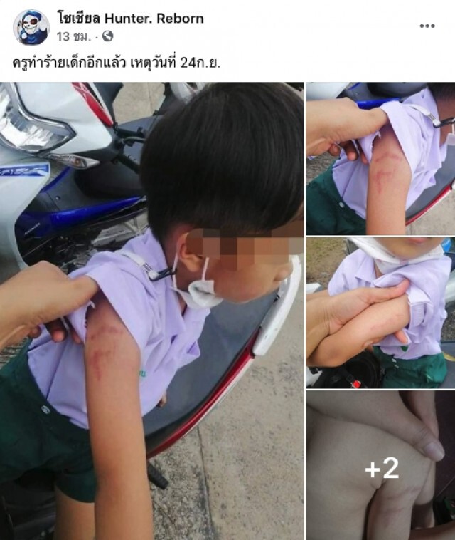 โผล่อีกราย แม่โพสต์ลูกชั้นอนุบาล 2 รร.เอกชนชื่อดัง ถูกครูทำร้าย พบร่องรอยคล้ายรอยหยิก