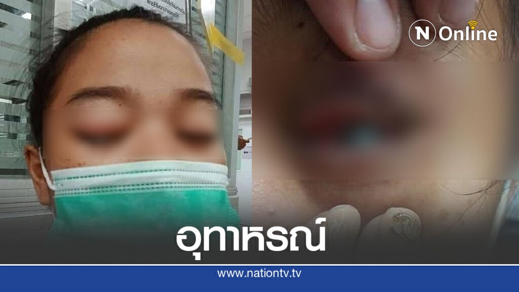 สาวโพสต์ เตือนภัย ตาเกือบบอดเพราะคอนแทคเลนส์