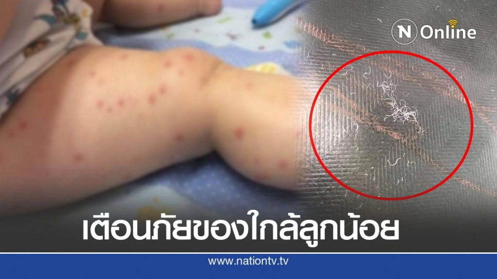 อุทาหรณ์ พ่อแม่ซื้อของออนไลน์ให้ลูก เกิดตุ่มแดงทั้งตัว แอดมิท รพ.ถึง2ครั้ง