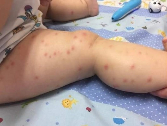 อุทาหรณ์ พ่อแม่ซื้อของออนไลน์ให้ลูก เกิดตุ่มแดงทั้งตัว แอดมิท รพ.ถึง2ครั้ง