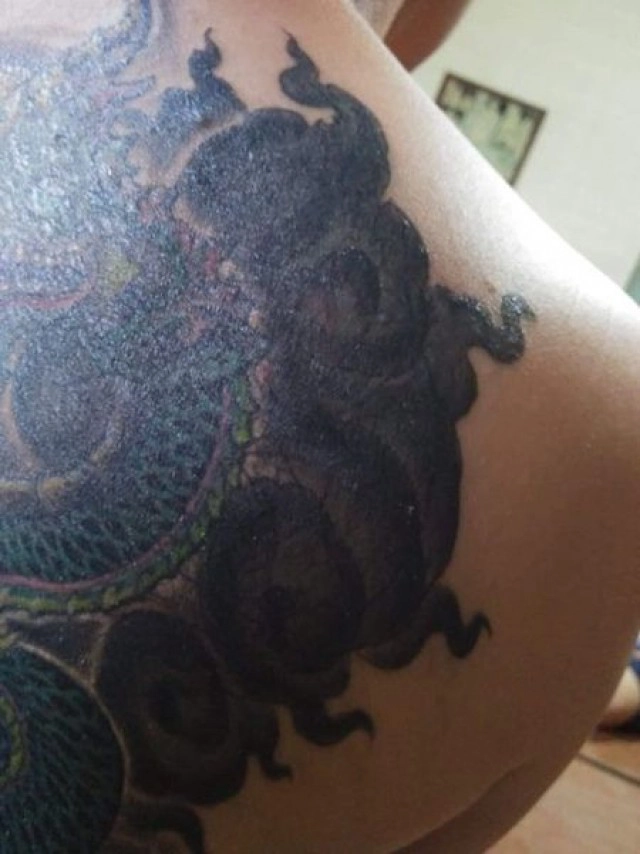 อัพเดท สาวสักพญานาค ช่างสักทำพิษ ติดเชื้ออย่างหนัก